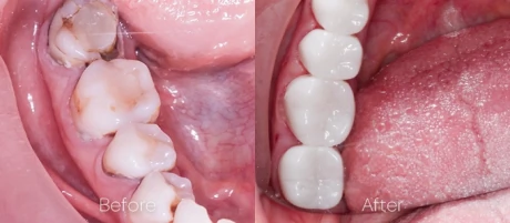 Inlay and dental crowns cost at Advanced Cabo Dentistry in Los Cabos