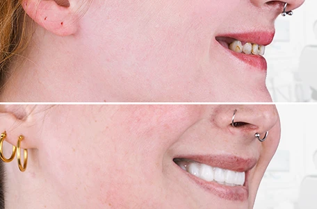 Dental crowns bridge cost in Los Cabos at Advanced Cabo Dentistry