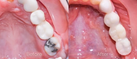 Onlay and dental crowns cost at Advanced Cabo Dentistry in Los Cabos